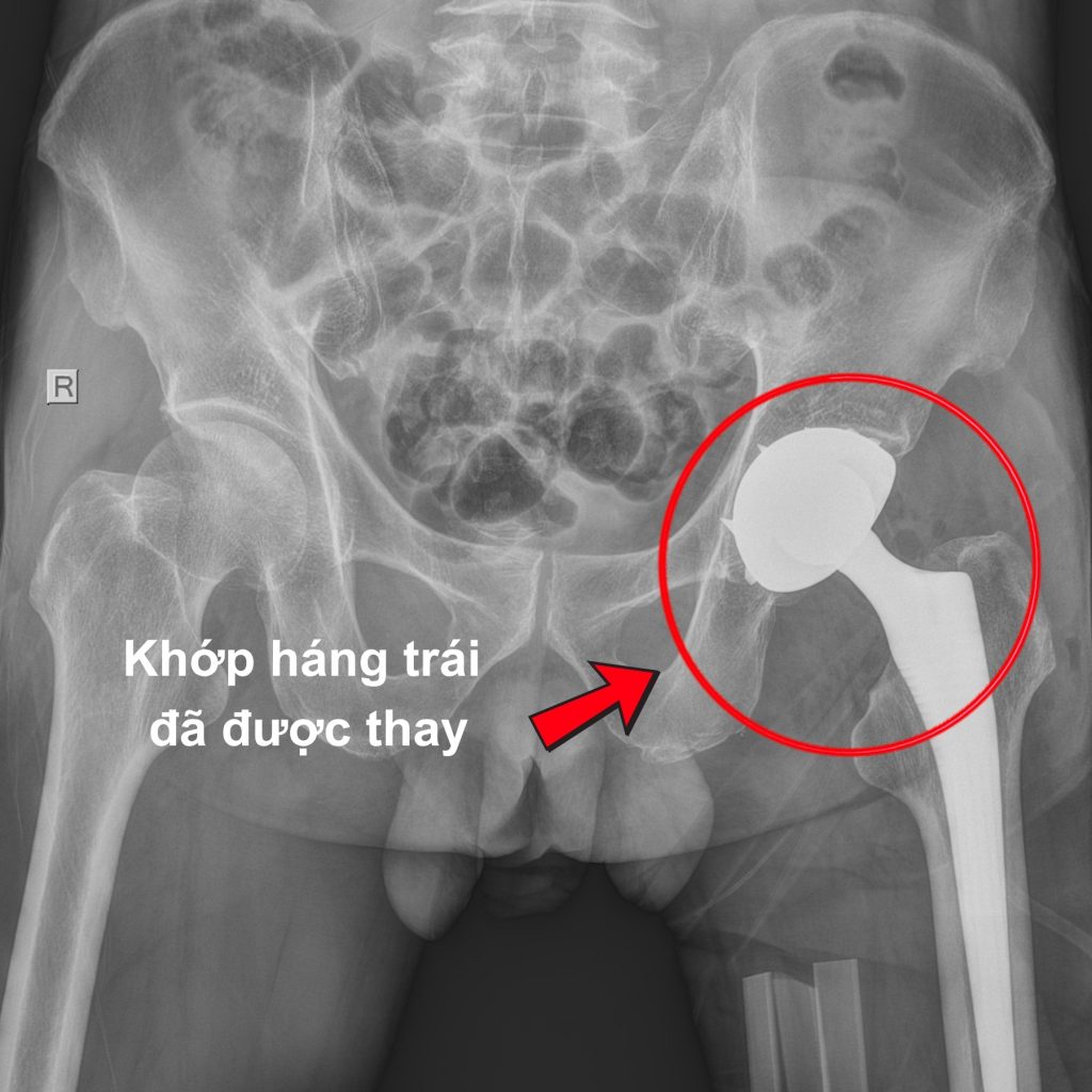 X-Quang sau phẫu thuật của bệnh nhân hoại tử chỏm xương đùi