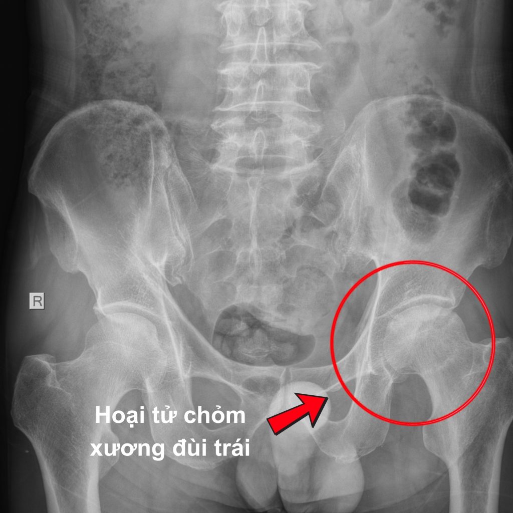 X-Quang trước phẫu thuật của bệnh nhân hoại tử chỏm xương đùi