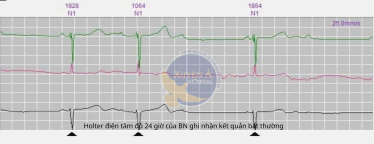 Holter điện tâm đồ 24 giờ của bệnh nhân ghi nhận kết quản bất thường nghi ngờ rối loạn nhịp tim