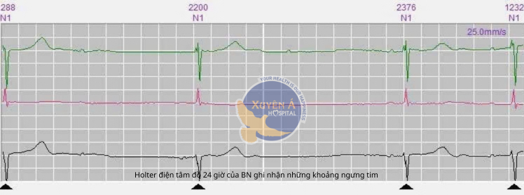 Holter điện tâm đồ 24 giờ của bệnh nhân ghi nhận những khoảng ngưng tim của bệnh nhân