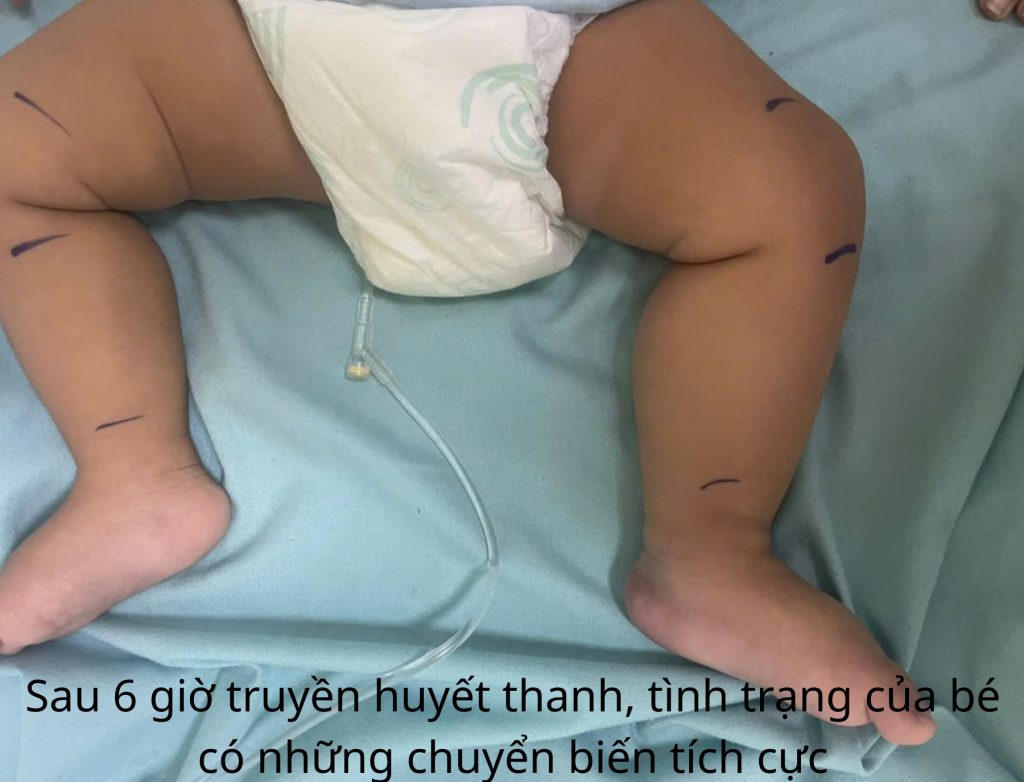 Bệnh nhi bị rắn lục đuôi đỏ cắn sau 6h truyền huyết thanh