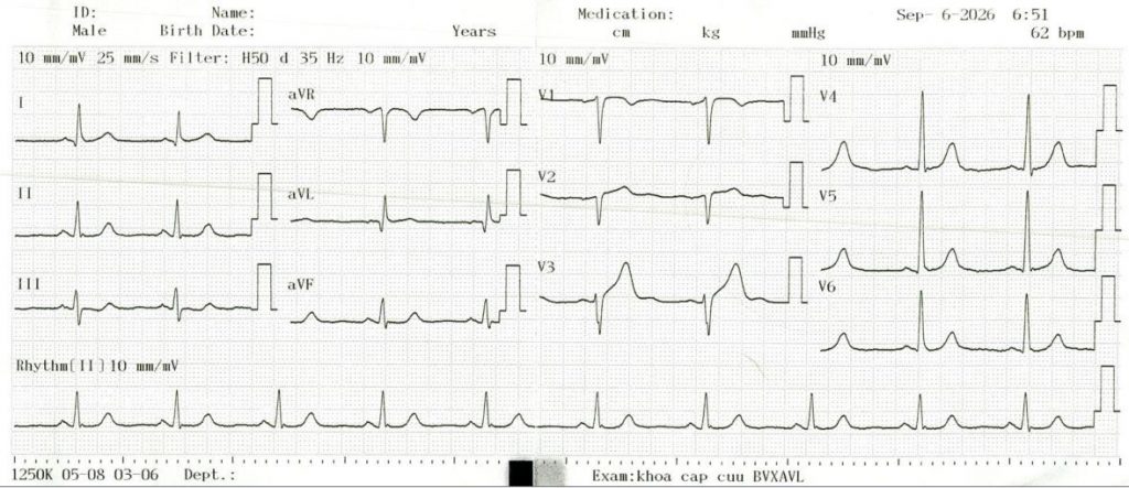 Điện tim đồ lúc nhập viện của bệnh nhân đau thượng vị