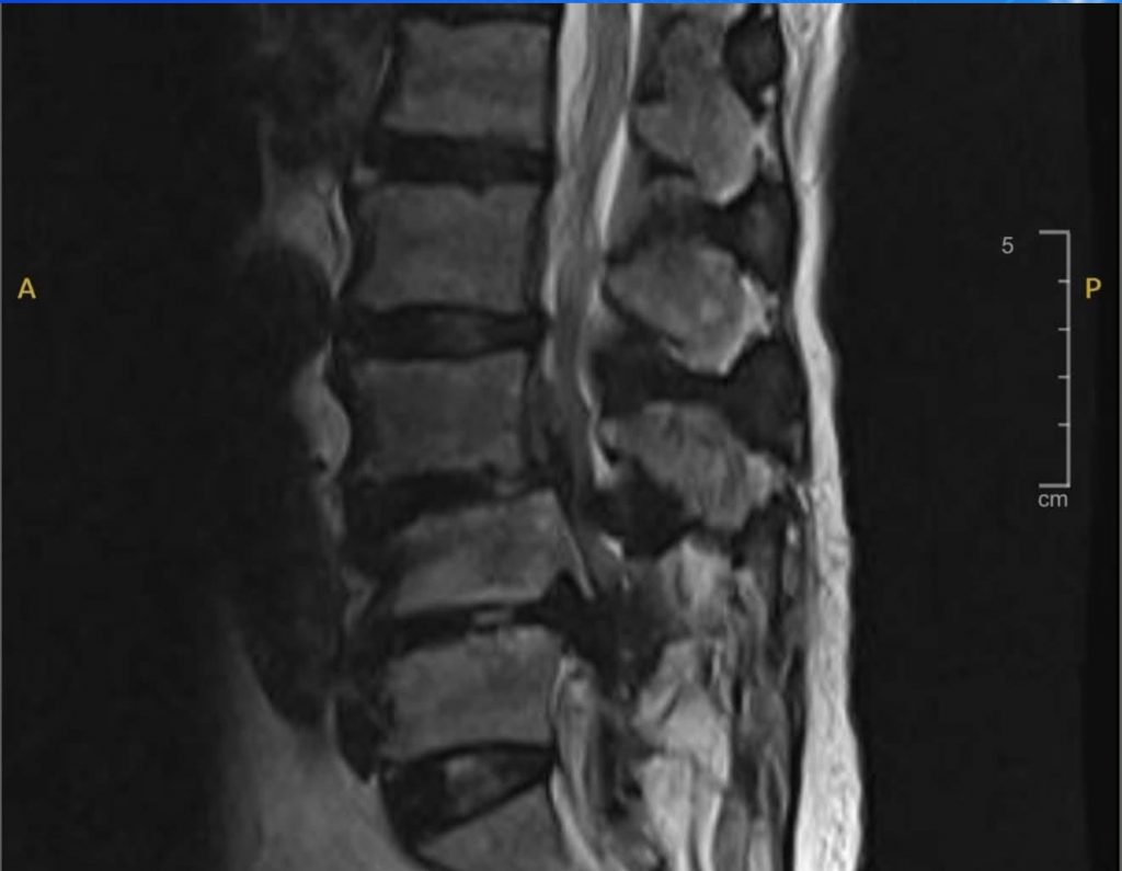 Hình ảnh MRI cột sống thắt lưng ghi nhận ổ áp xe ngoài màng cứng chèn ép các cấu trúc thần kinh
