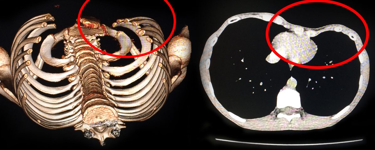 Ảnh CT160 lát kết hợp dựng hình 3D: lồng ngực em V. lõm về phía bên trái.