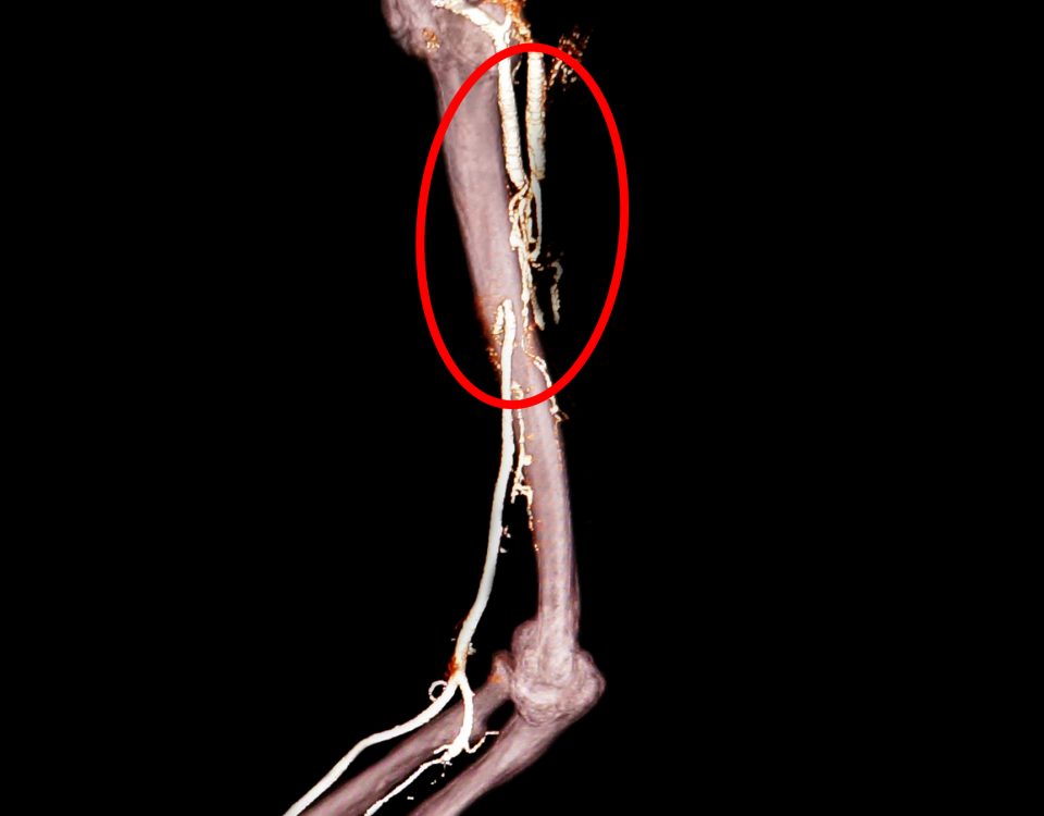 Ảnh chụp CT 160 lát cắt dựng 3D động mạch cánh tay phải.