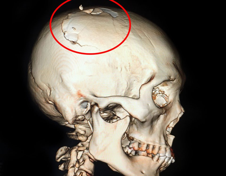 Ành CT 160 lát dựng 3D: sọ não bệnh nhân nứt vỡ do bị chém.