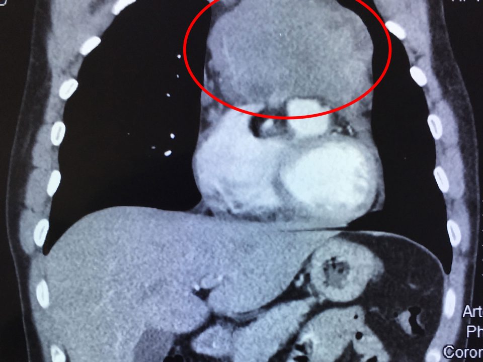Hình chụp cắt lớp vi tính (CT) 160 lát: khối u xuất phát từ trung thất trước, xâm lấn rộng vào màng ngoài tim, tĩnh mạch vô danh, thần kinh hoành bên trái, động mạch phổi và lan ra sau dính vào động mạch chủ ngực xuống.