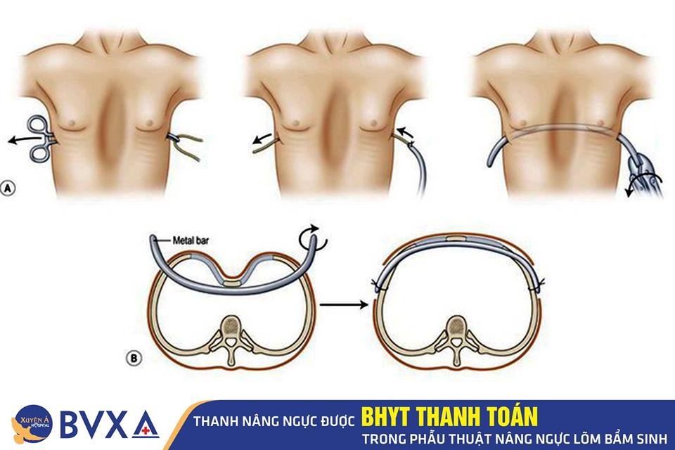 Phẫu Thuật Ngực: Tất Tần Tật Những Điều Cần Biết Để Quyết Định Thông Minh