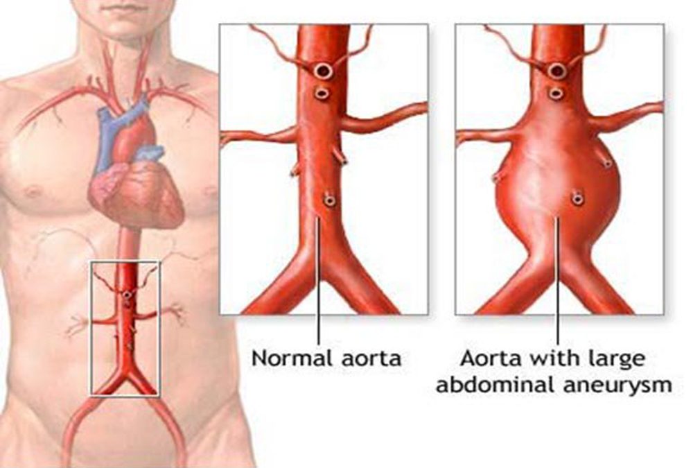 Phình động mạch chủ bụng là gì? Nguyên nhân, triệu chứng và cách phòng ngừa