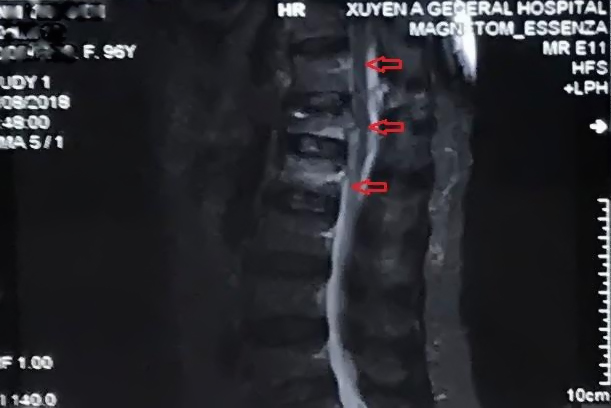 Hình ảnh xẹp D12, L1 và phù tủy xương nhiều trên xung STIR D11, D12, L1 của cụ bà S. 96 tuổi.