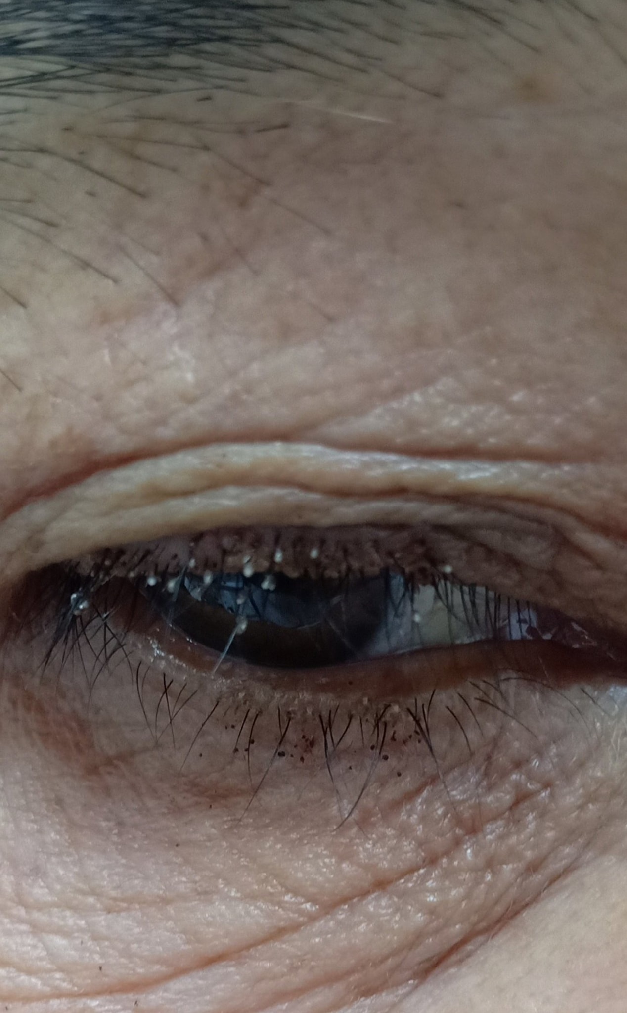 Rận mu mi mắt có thể lây lan và gây nguy hiểm cho sức khỏe không?
