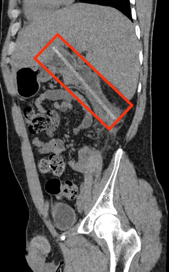 1-Hình ảnh CT phát hiện dị vật