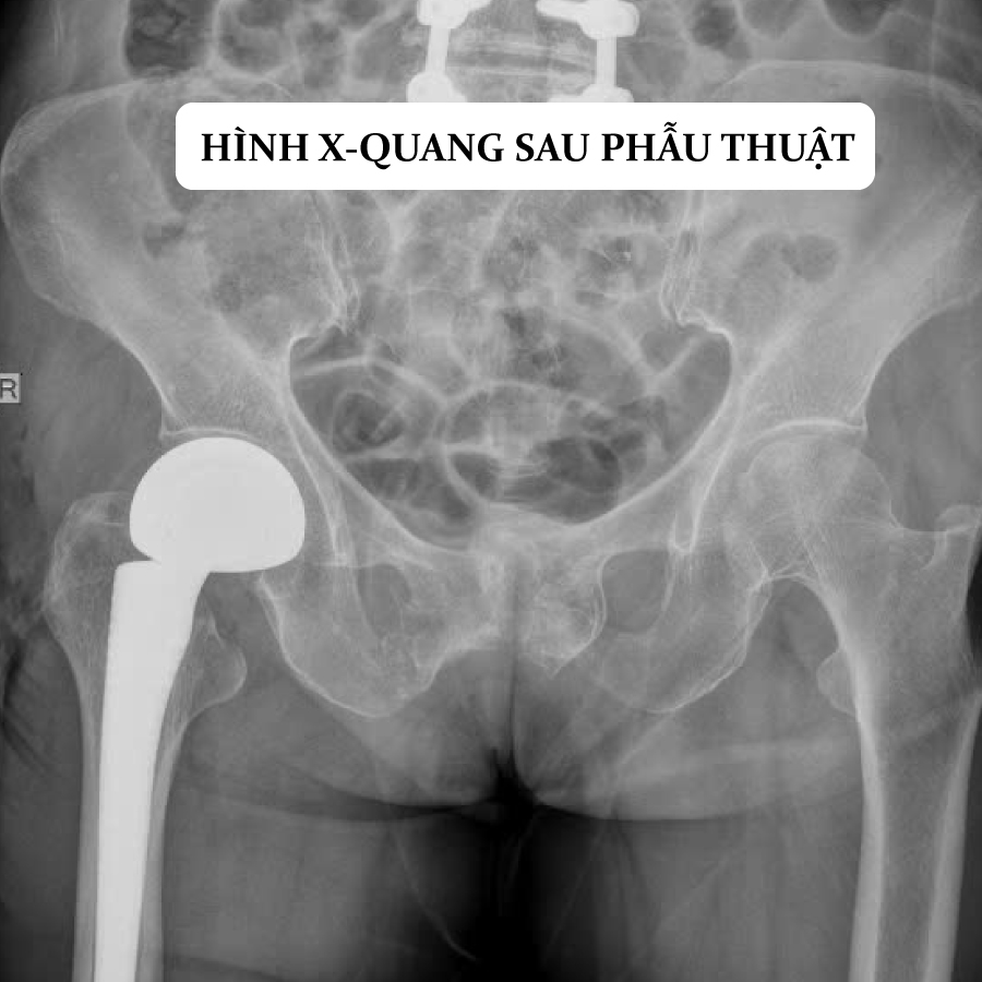 HÌNH-XQUANG-TRƯỚC-SAU-THUẬT