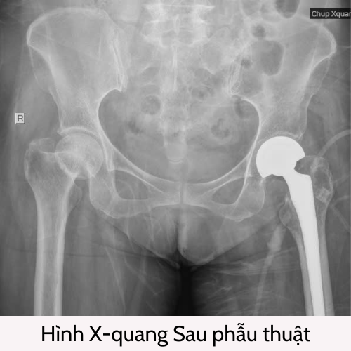 HÌNH X-QUANG SAU PHẪU THUẬT