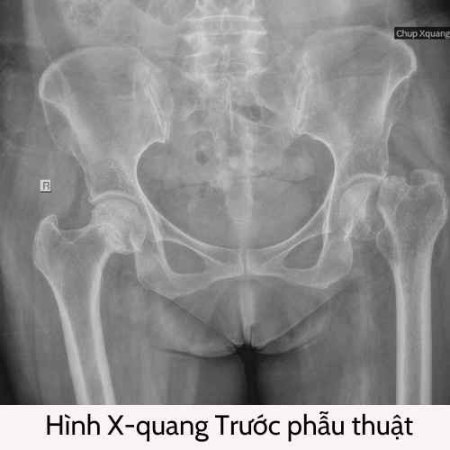 HÌNH X-QUANG TRƯỚC PHẪU THUẬT