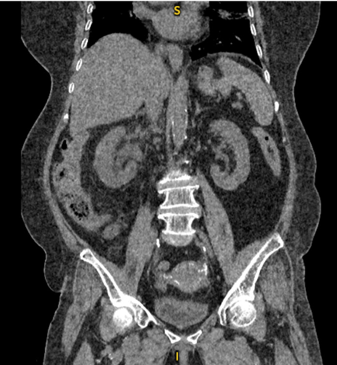 Hình ảnh CT trước phẫu thuật