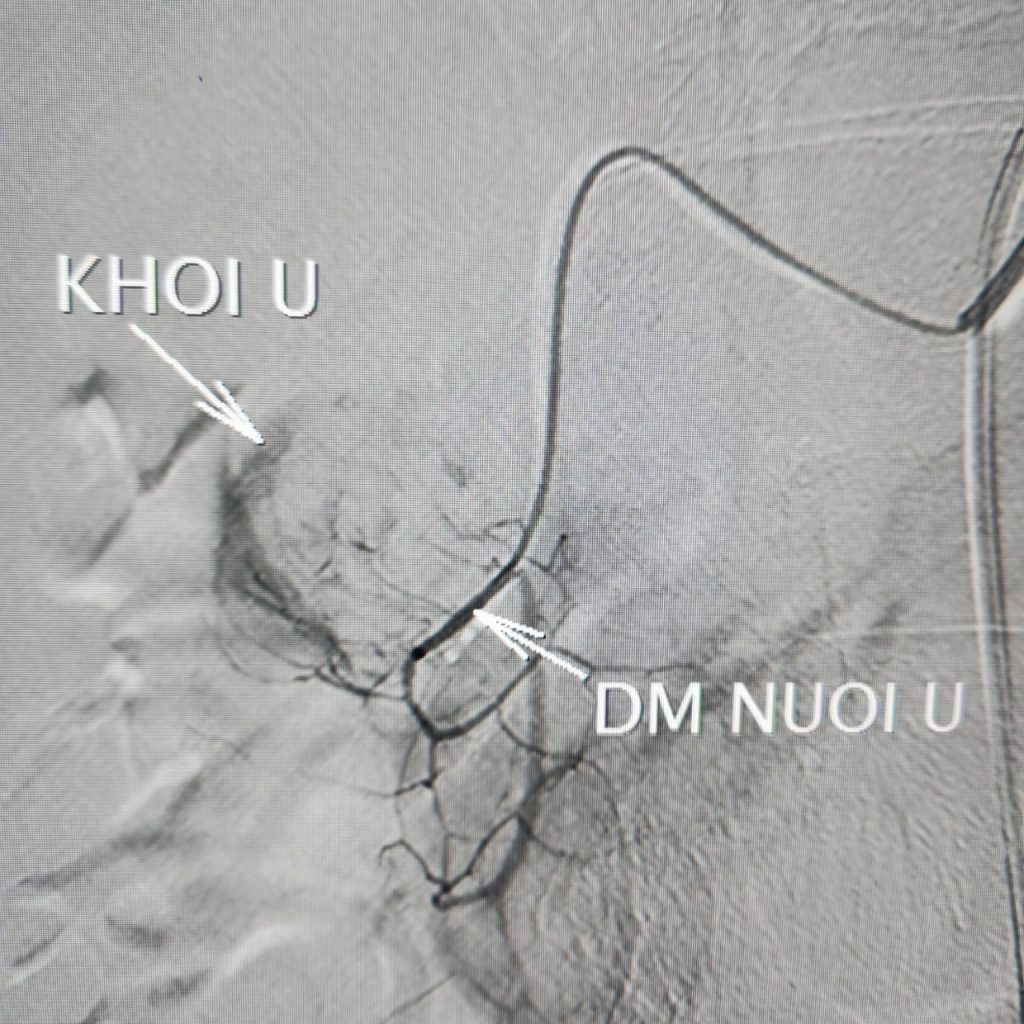 Vị trí khối u và động mạch nuôi u