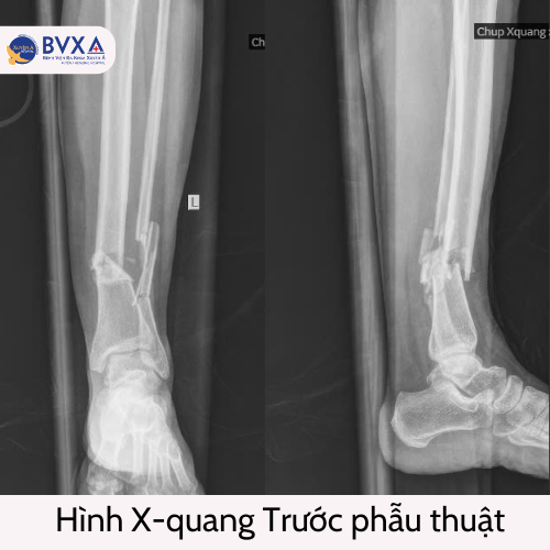 X-QUANG TRƯỚC PHẪU THUẬT