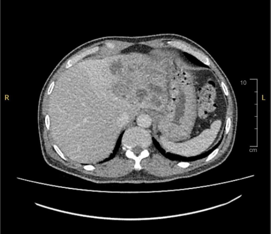 Hình ảnh CT phát hiện gan bị tổn thương