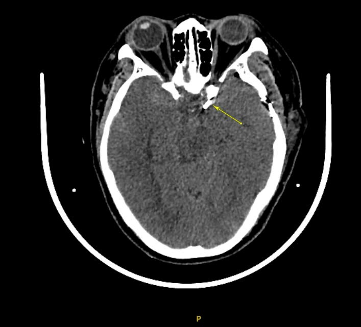 Hình ảnh chụp CT trước phẫu thuật