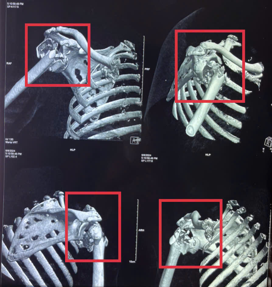 Hình ảnh chụp CT vùng xương bị gãy nát