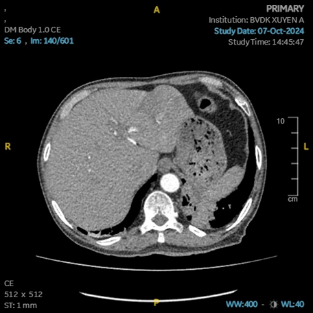 Hình ảnh tổn thương gan rất rõ khi chụp MRI với chất tương phản đặc hiệu mô gan