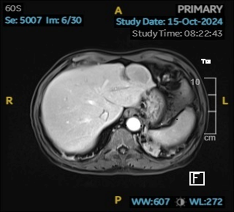 Hình ảnh tổn thương gan rất rõ khi chụp MRI với chất tương phản đặc hiệu mô gan