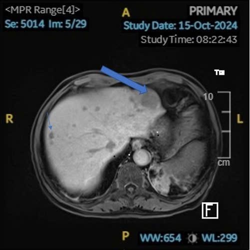 Hình ảnh tổn thương gan rất rõ khi chụp MRI với chất tương phản đặc hiệu mô gan (Mũi tên lớn HCC tái phát, mũi tên nhỏ nốt di căn)