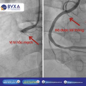 Hình ảnh động mạch bệnh nhân trong quá trình phẫu thuật
