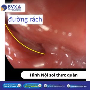 Hình ảnh nội soi thực quản