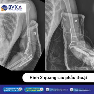 Hình X-quang sau phẫu thuật