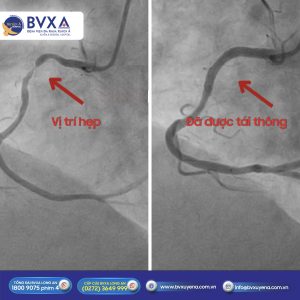 Hình ảnh động mạch bệnh nhân trong quá trình phẫu thuật