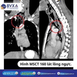 Hình MSCT 160 lát lồng ngực