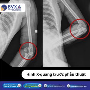 Hình X-quang trước phẫu thuật