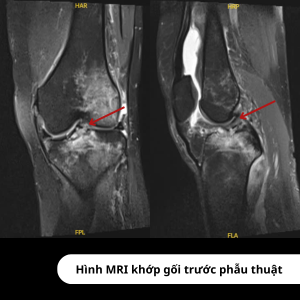 Hình ảnh MRI trước phẫu thuật