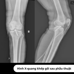 Hình ảnh X-quang sau phẫu thuật
