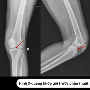 Hình ảnh X-quang trước phẫu thuật