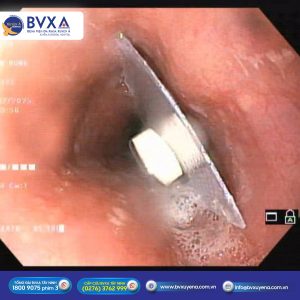 Hình ảnh viên thuốc nằm trong đường tiêu hoá của bệnh nhân