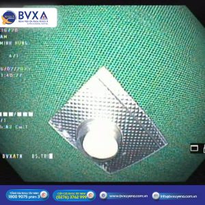 Hình ảnh viên thuốc sau khi lấy ra thành công