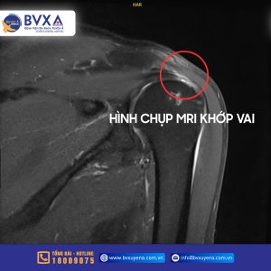 Hình ảnh chụp khớp vai