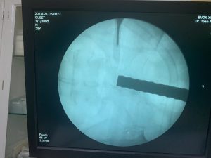 Hình ảnh CT cho thấy thanh sắt đâm xuyên