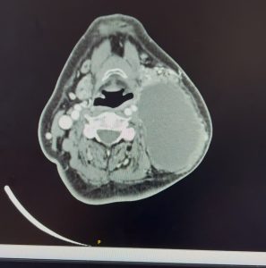 Hình ảnh CT khối u trước mổ