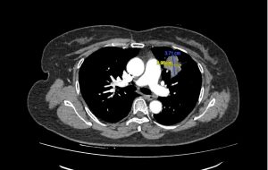 Hình ảnh CT phát hiện khối u phổi