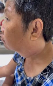 Khối u nang khe mang kích thước lớn trước phẫu thuật