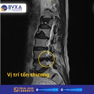 Hình ảnh chụp MRI thoát vị đĩa đệm cột sống lưng