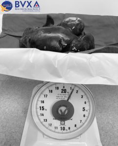 Hình ảnh khối u nang lách nặng 32 gram
