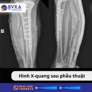 Ảnh X-quang sau phẫu thuật của bệnh nhân vấp phải “ổ gà” mất lái té ngã gây biến dạng đầu gối nghiêm trọng