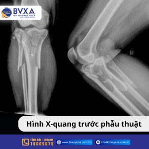 Ảnh X-quang trước phẫu thuật của bệnh nhân vấp phải “ổ gà” mất lái té ngã gây biến dạng đầu gối nghiêm trọng