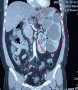 Hình ảnh CTscan