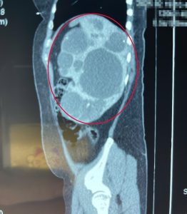 Hình ảnh CTscan